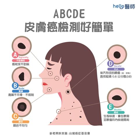 手臂長痣|皮膚長痣、長斑是皮膚癌前兆？皮膚癌初期4大症狀快。